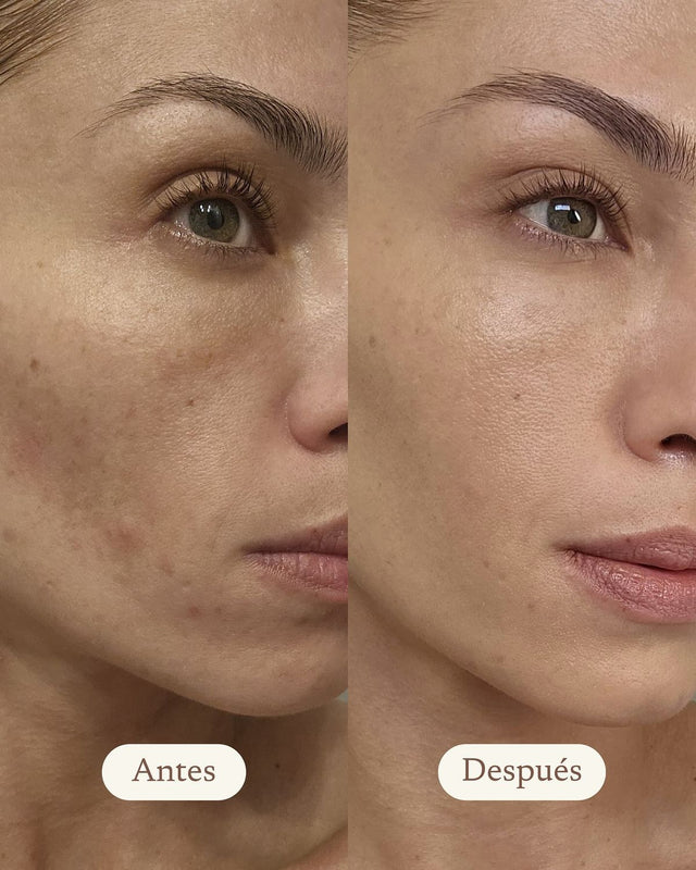 Antes e depois do tratamento com Hidratante Multifuncional Yourskin